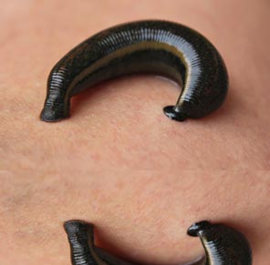 Blutegel-Therapie Blutegel-Therapie